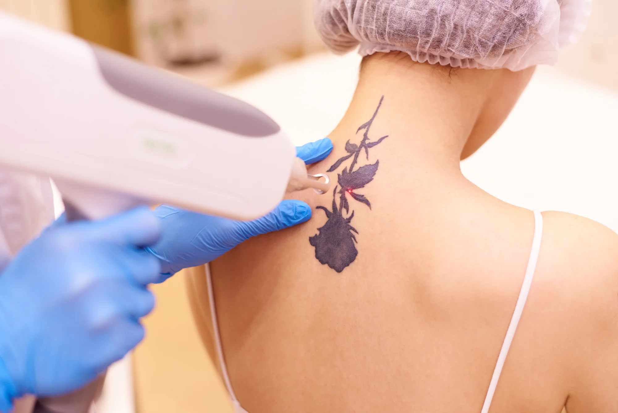 PicoWay Tattoo Removal in Brooklyn, NY