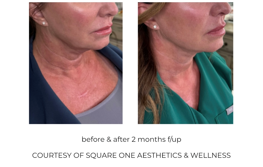 PulseGlow Infusion: Needle-Free Skin Rejuvenation