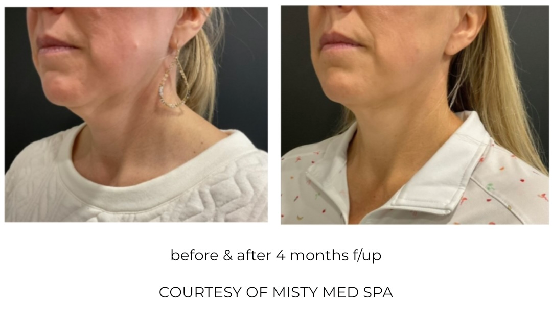PulseGlow Infusion: Needle-Free Skin Rejuvenation
