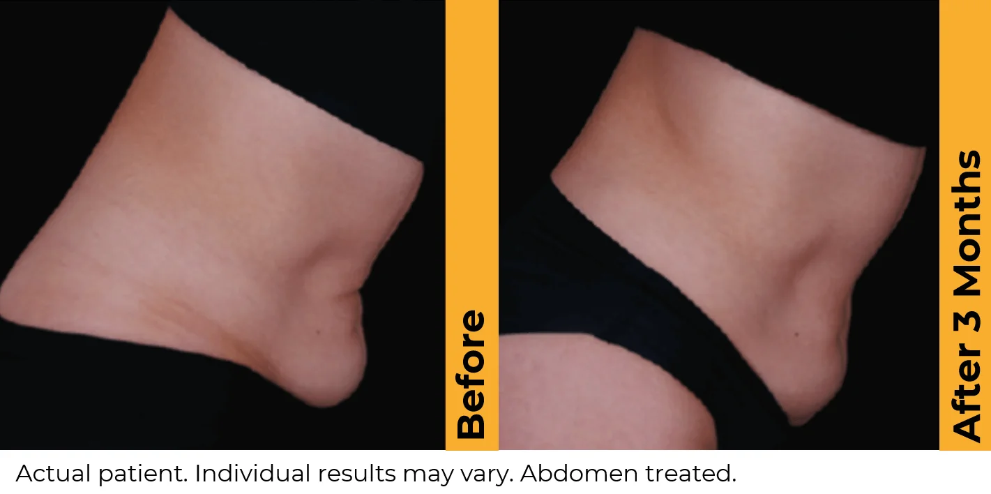 Ultherapy-before-after-by-khrom-med-spa-in-Brooklyn-NY