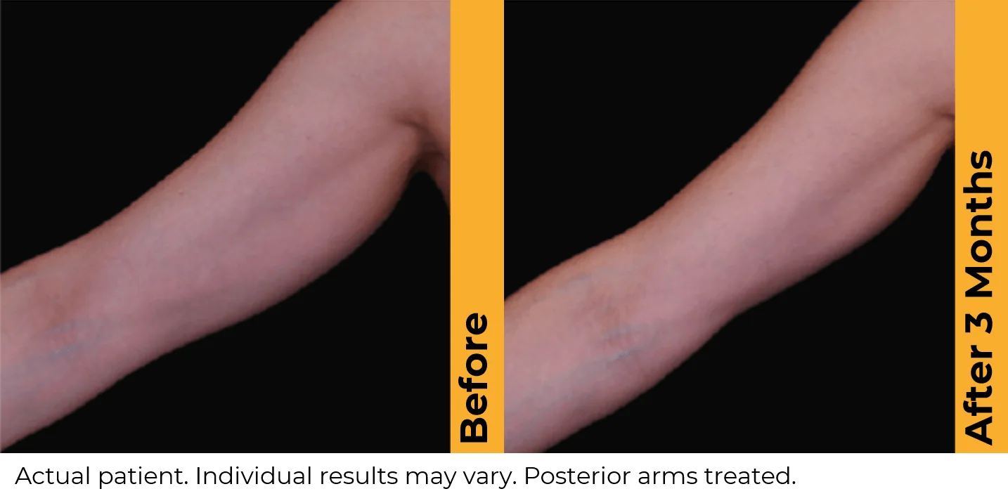 Ultherapy-before-after-by-khrom-med-spa-in-Brooklyn-NY