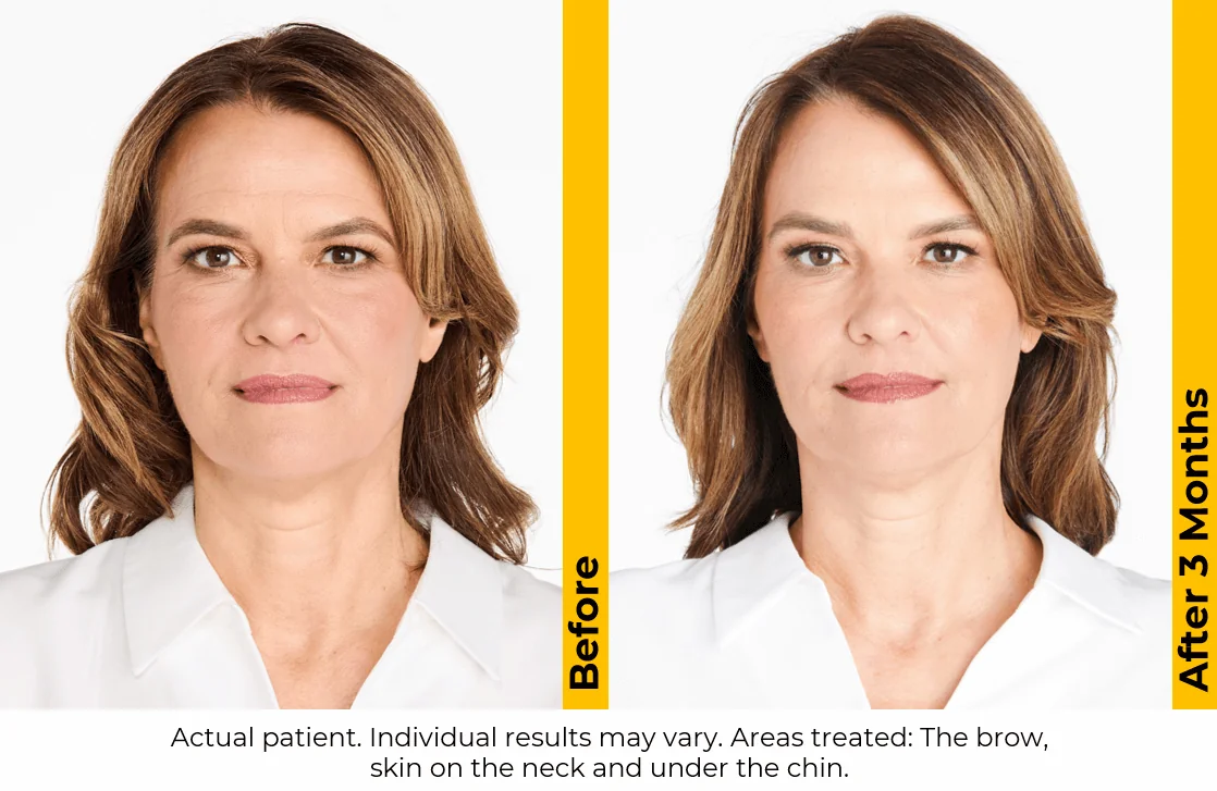 Ultherapy-before-after-by-khrom-med-spa-in-Brooklyn-NY