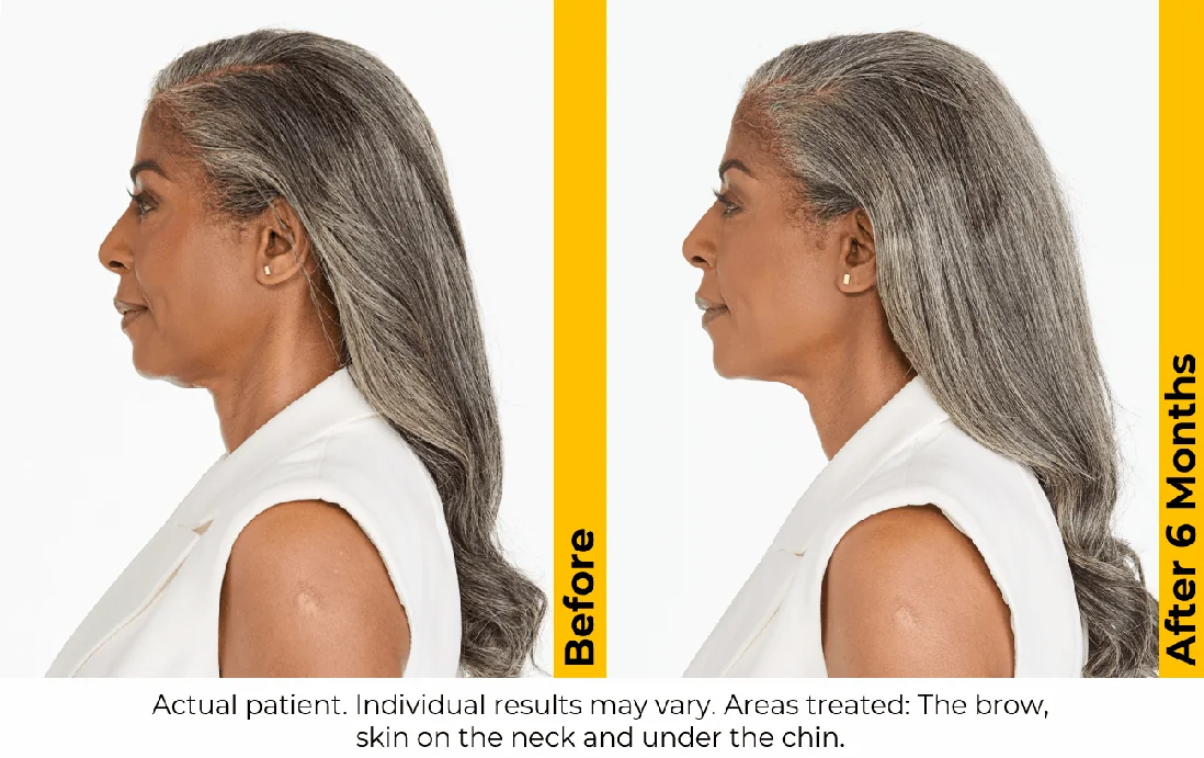 Ultherapy-before-after-by-khrom-med-spa-in-Brooklyn-NY