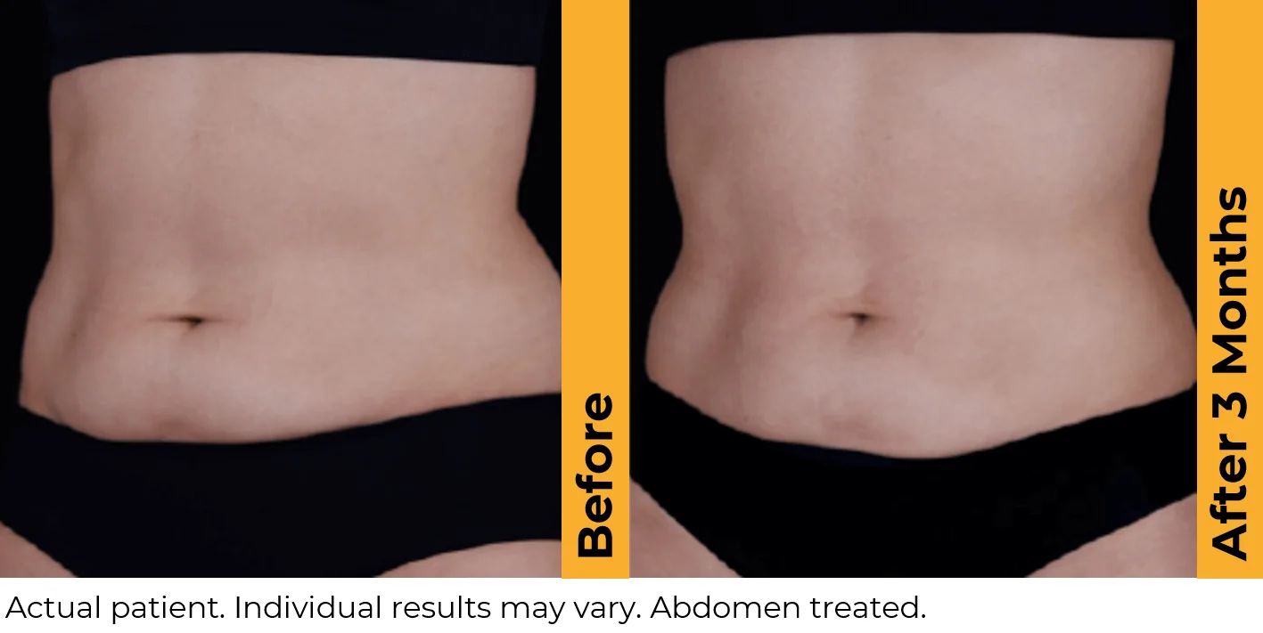 Ultherapy-before-after-by-khrom-med-spa-in-Brooklyn-NY