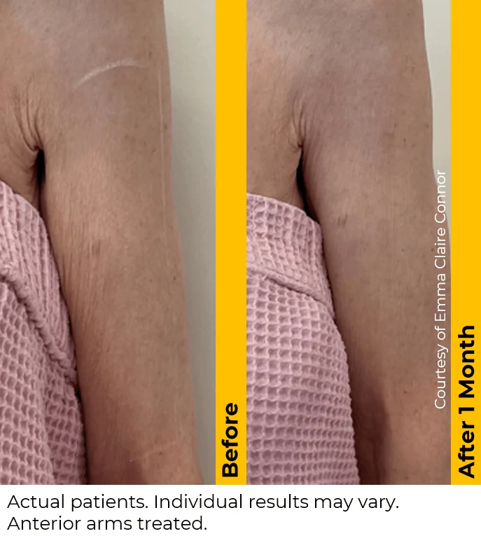 Ultherapy-before-after-by-khrom-med-spa-in-Brooklyn-NY