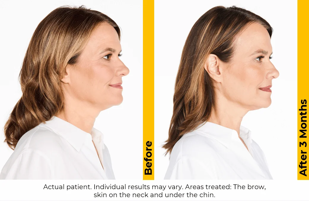 Ultherapy-before-after-by-khrom-med-spa-in-Brooklyn-NY