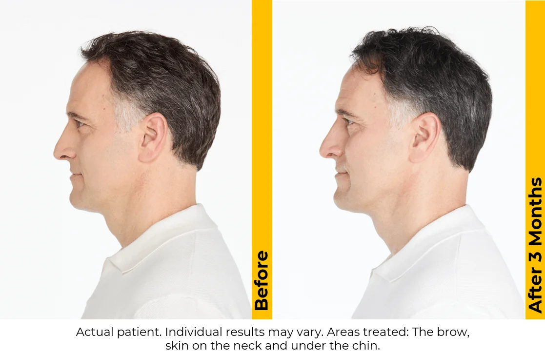 Ultherapy-before-after-by-khrom-med-spa-in-Brooklyn-NY