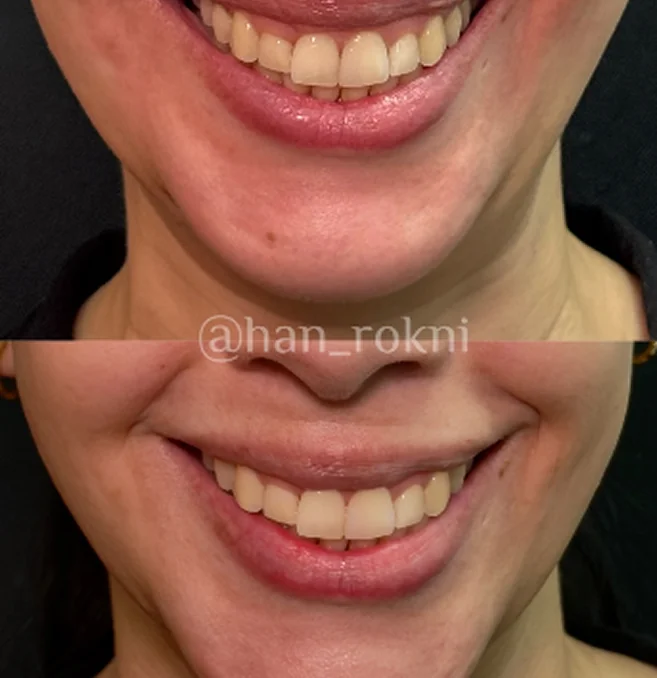 Before and After Image of Treatment