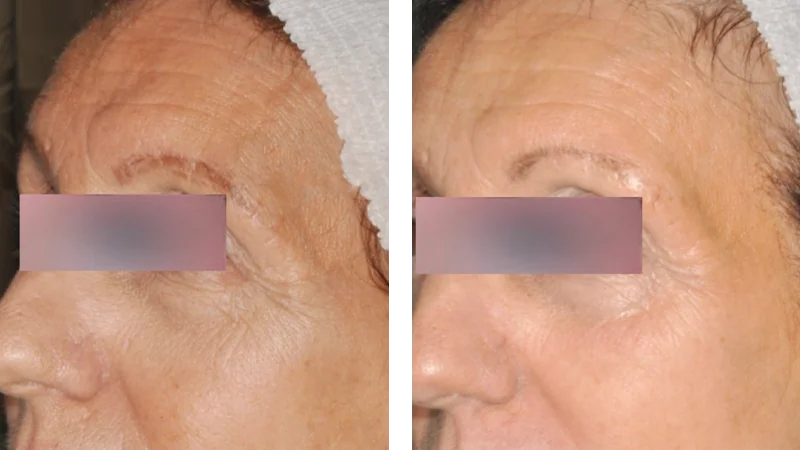 nordlys-before-after-by-khrom-med-spa-in-Brooklyn-NY
