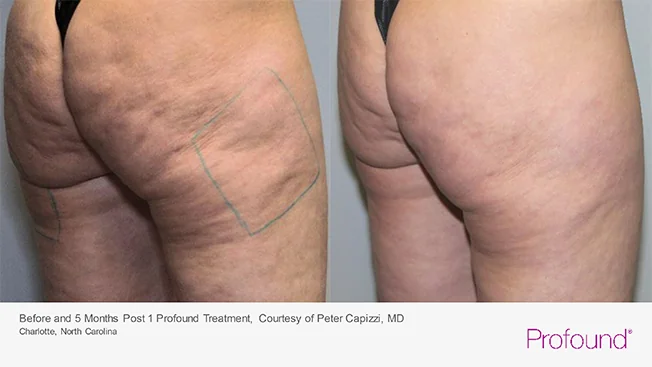 profound-before-after-by-khrom-med-spa-in-Brooklyn-NY