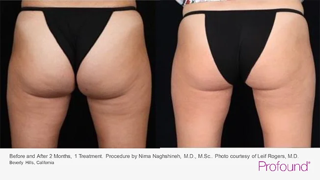 profound-before-after-by-khrom-med-spa-in-Brooklyn-NY