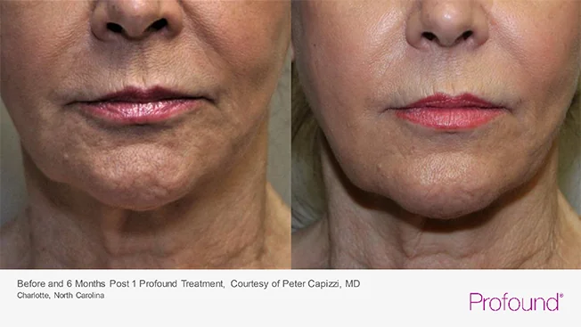 Profound® Skin Tightening before and After