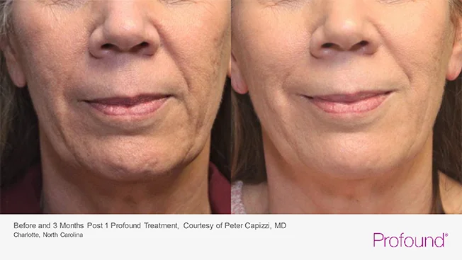 Before and After Profound® Skin Tightening