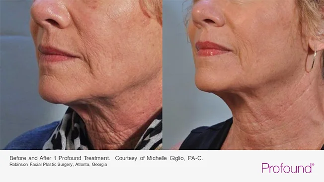 profound-before-after-by-khrom-med-spa-in-Brooklyn-NY