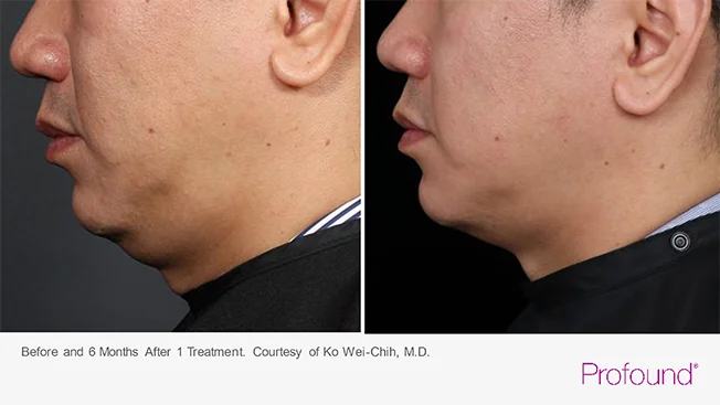 Profound® Skin Tightening Before and After