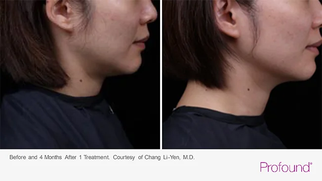 profound-before-after-by-khrom-med-spa-in-Brooklyn-NY