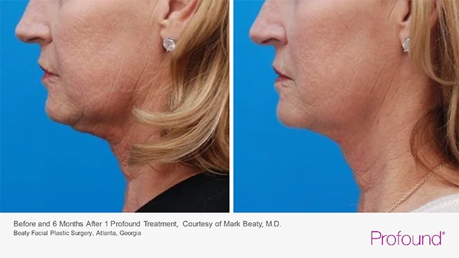 profound-before-after-by-khrom-med-spa-in-Brooklyn-NY