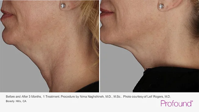profound-before-after-by-khrom-med-spa-in-Brooklyn-NY