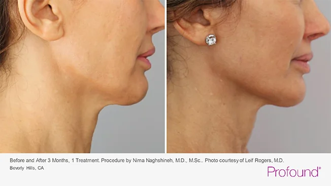 profound-before-after-by-khrom-med-spa-in-Brooklyn-NY