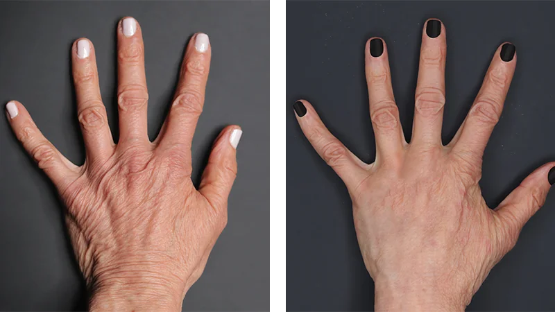 Renuva® Injections before and After