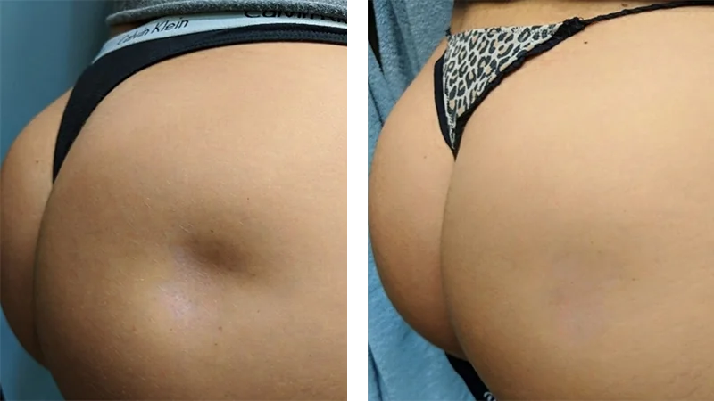 Before and After Renuva® Injections