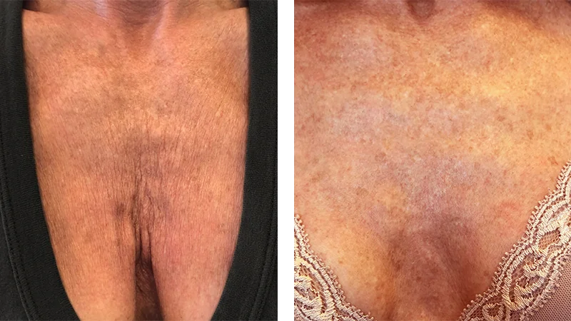 Before and After Renuva® Injections