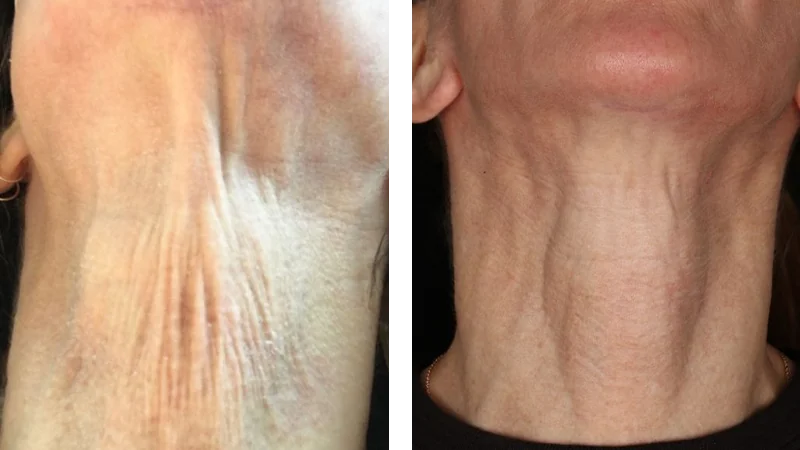Renuva® Injections Before and after