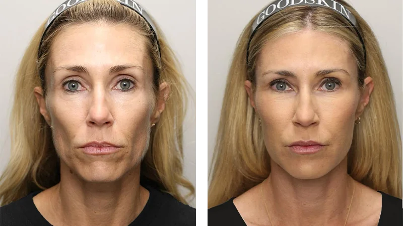 Renuva® Injections Before and After