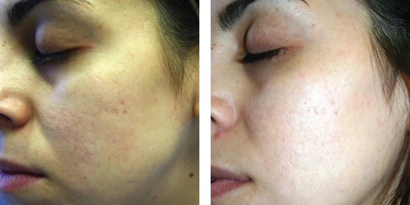 sublative-before-after-by-khrom-med-spa-in-Brooklyn-NY