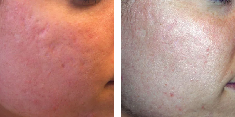 Before and after image of Sublative RF Microneedling