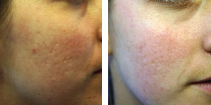 Before and after image of Sublative RF Microneedling