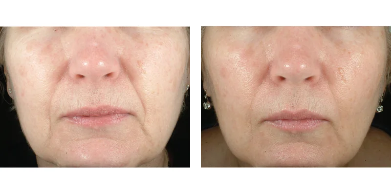 Before and after treatment of Sublative RF Microneedling