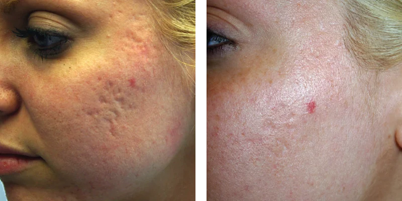 Before and after treatment of Sublative RF Microneedling