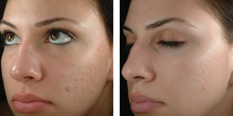 Before and After Sublative RF Microneedling