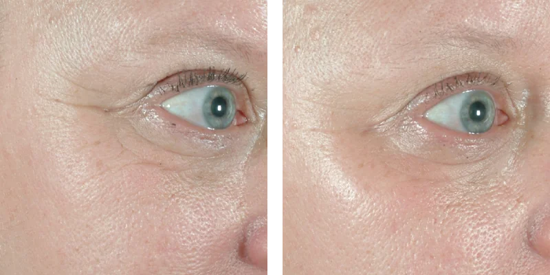 Before and After Treatment Sublative RF Microneedling
