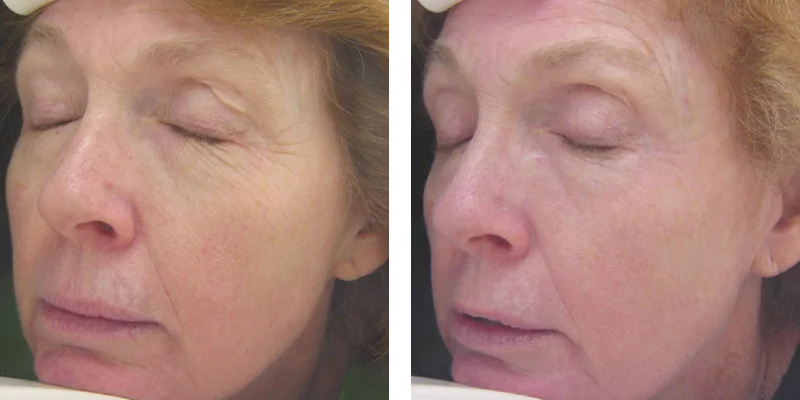 sublative-before-after-by-khrom-med-spa-in-Brooklyn-NY