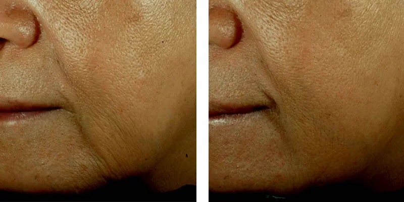 Before and after Sublime RF Skin Tightening