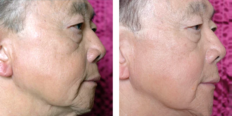 Sublime RF Skin Tightening