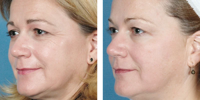 Before and After image of Sublime RF Skin Tightening