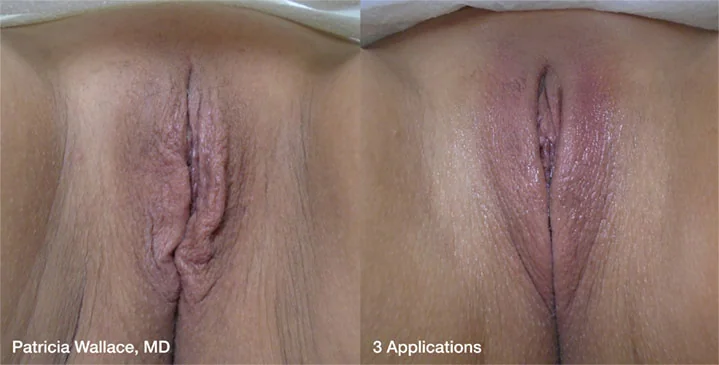 Before and After ThermiVa® Intimate Rejuvenation