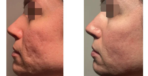 Before and After Acne Scarring Treatment
