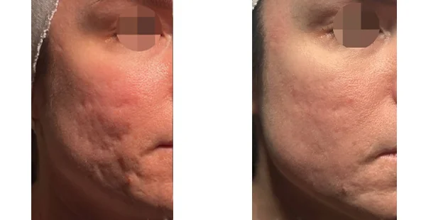 Before and After Acne Scarring Treatment