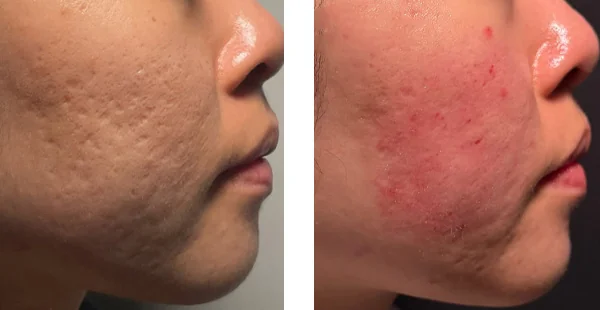 Before and After Acne Scarring Treatment