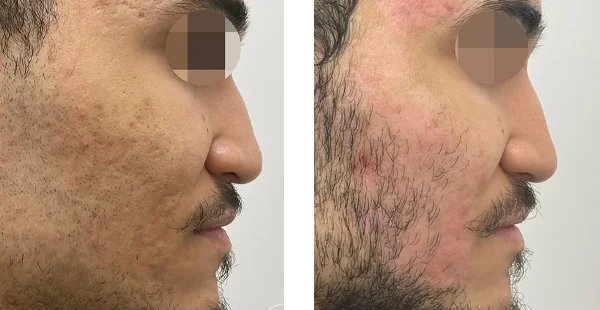 Before and After Acne Scarring Treatment