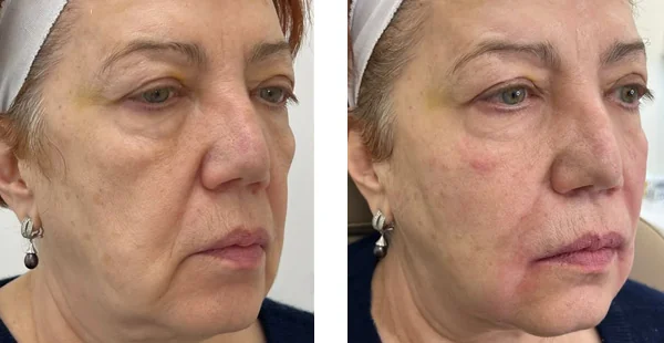 before-after-by-khrom-med-spa-in-Brooklyn-NY