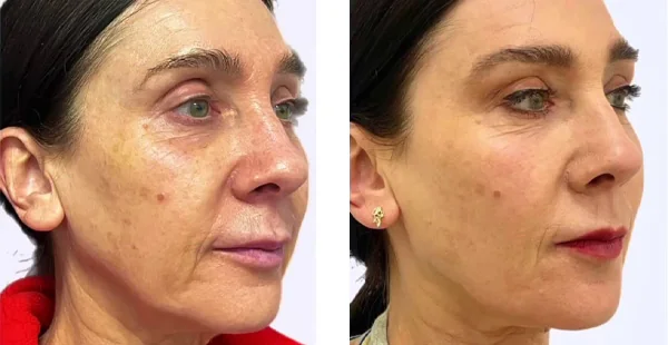 before-after-by-khrom-med-spa-in-Brooklyn-NY