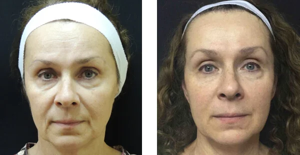 before-after-by-khrom-med-spa-in-Brooklyn-NY