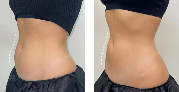 before-after-by-khrom-med-spa-in-Brooklyn-NY