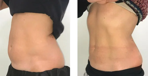 before-after-by-khrom-med-spa-in-Brooklyn-NY