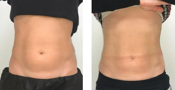 before-after-by-khrom-med-spa-in-Brooklyn-NY